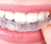 Invisalign